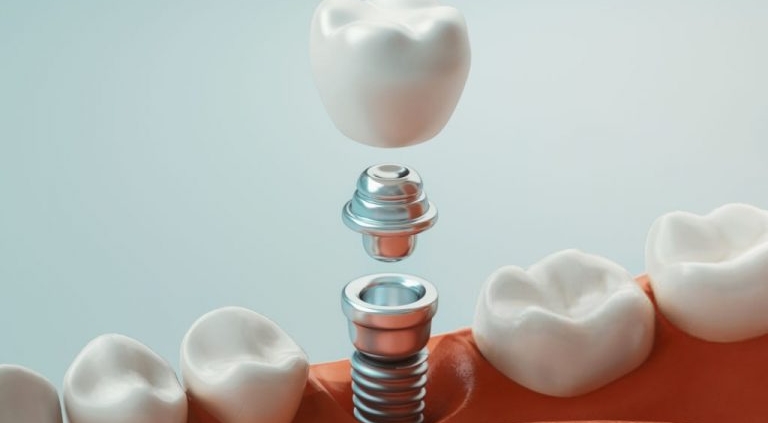 Understand the benefits of dental implants