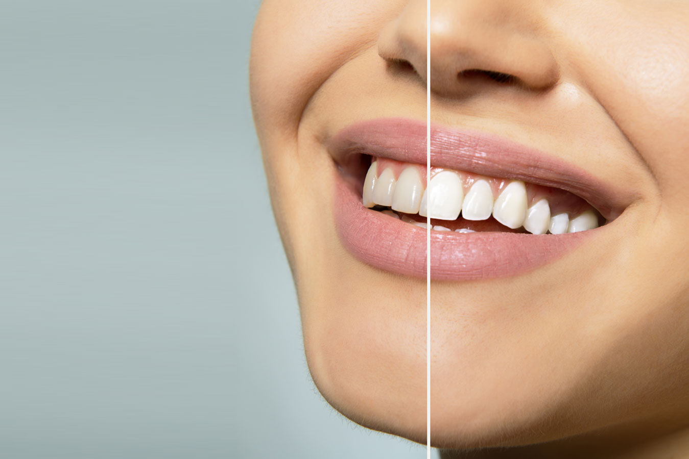 choices for teeth whitening